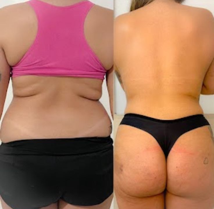 Resultado de hidrolipo, visão das costas Antes e depois de Hidrolipo na região abdominal, visão do resultado nas costas da paciente