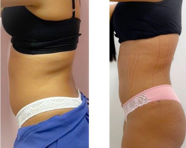 antes e depois de hidrolipo Antes e depois do procedimento Hidrolipo na região abdominal