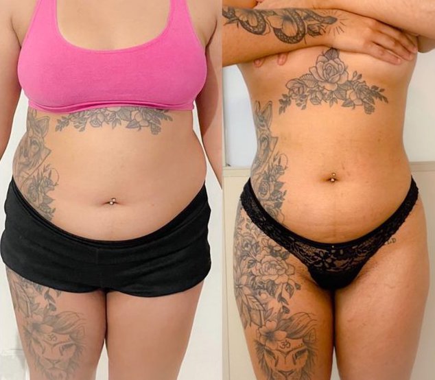 antes e depois de Hidrolipo no abdômen antes e depois de Hidrolipo na região abdominal
