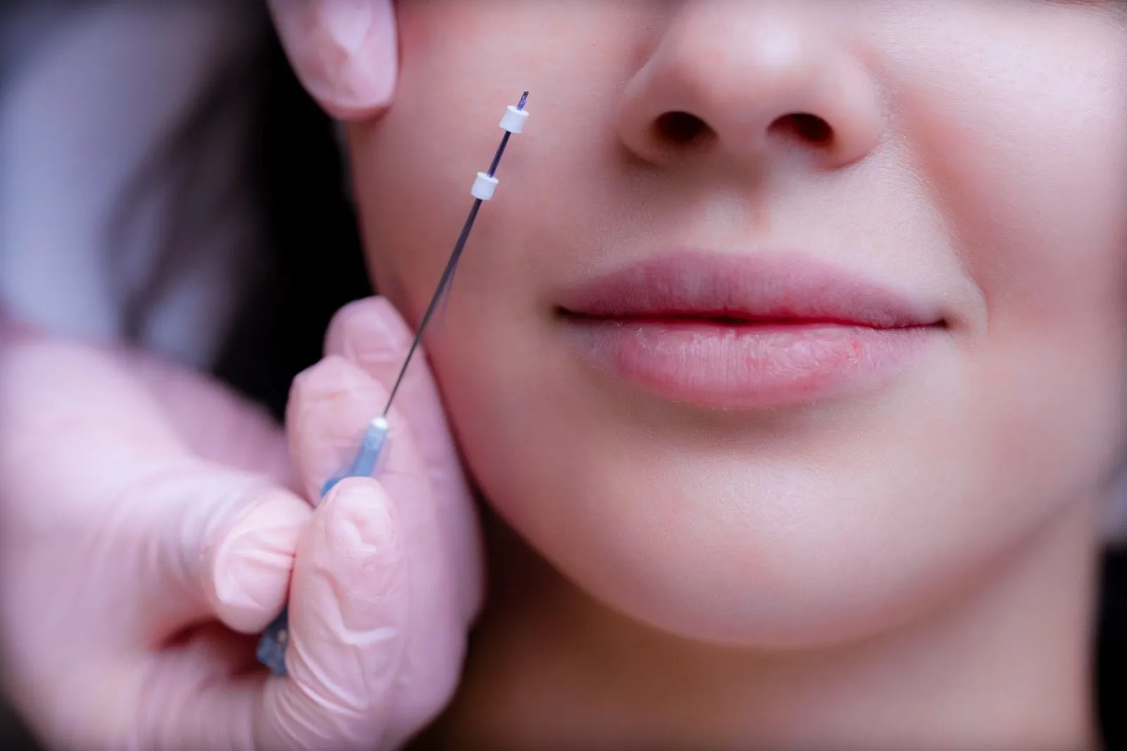 Fios de PDO: tecnologia avançada para firmeza, sustentação e rejuvenescimento da pele