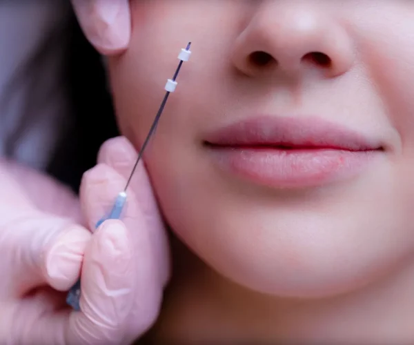 Fios de PDO: tecnologia avançada para firmeza, sustentação e rejuvenescimento da pele